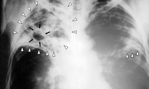 Ограничения из-за коронавируса могут привести к гибели 1,4 млн человек от туберкулеза